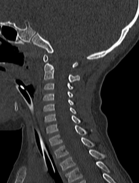 Normal CT cervical spine - pediatric (Radiopaedia 52549-58462 Sagittal bone window 88).jpg