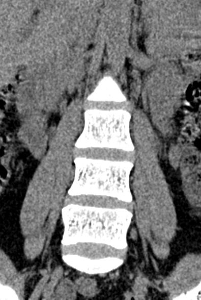 Normal CT lumbar spine (Radiopaedia 53981-60118 F 23).jpg