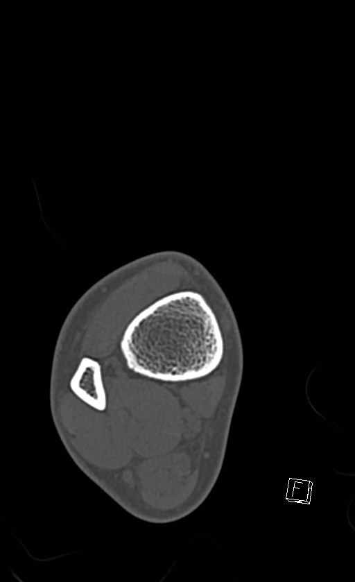 Normal CT of the ankle (Radiopaedia 47111-51658 Axial bone window 13).jpg