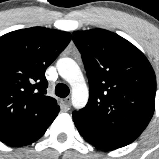 File:Normal CT pulmonary veins (pre RF ablation) (Radiopaedia 41748-44702 A 9).png