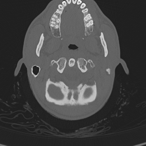 Normal CT skull (Radiopaedia 40798-43459 A 7).png