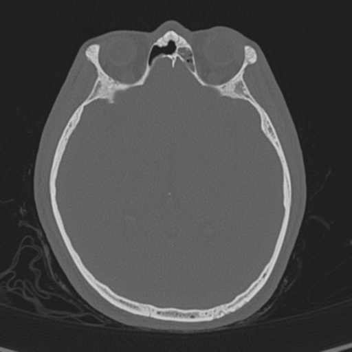 Normal CT skull (Radiopaedia 40798-43459 A 75).png