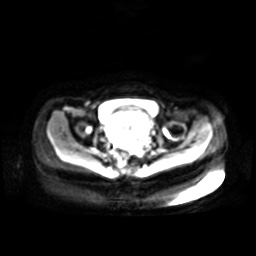 Normal MRI abdomen in pregnancy (Radiopaedia 88001-104541 Axial DWI 2).jpg