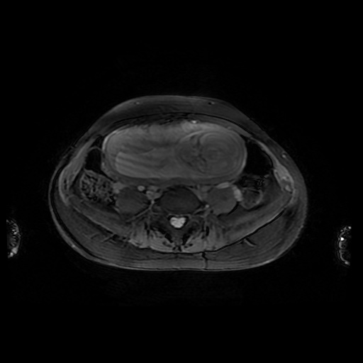 File:Normal MRI abdomen in pregnancy (Radiopaedia 88001-104541 D 36).jpg
