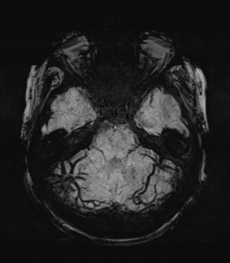 Normal MRI internal auditory canal (Radiopaedia 41613-44525 Axial SWI MIP 22).png