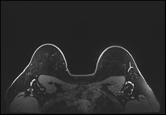 Normal breast MRI - dense breasts (Radiopaedia 80454-93850 C 195).jpg