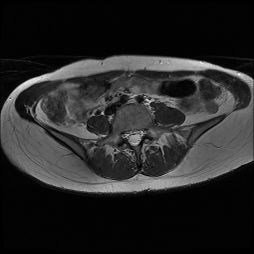 File:Normal female pelvis MRI (retroverted uterus) (Radiopaedia 61832-69933 Axial T2 2).jpg