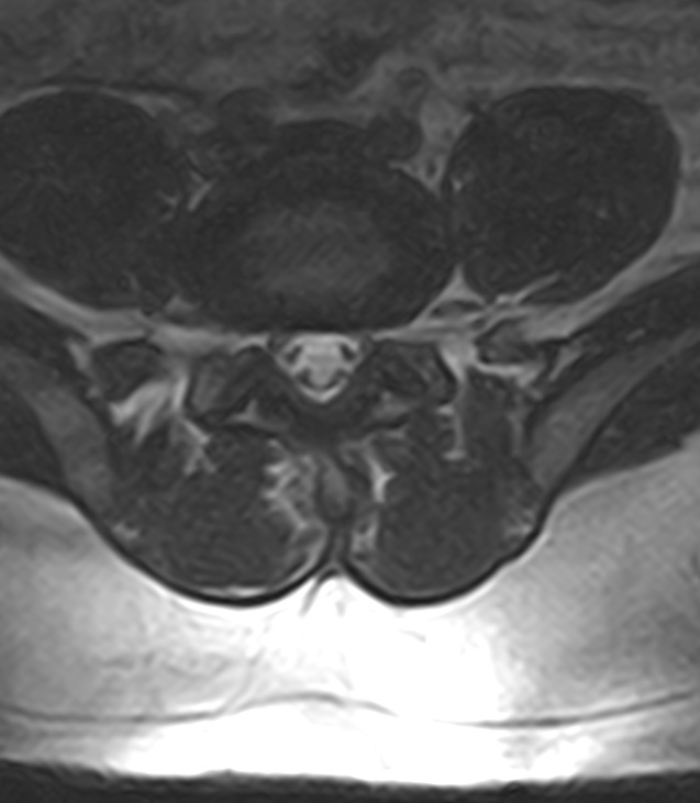 Normal lumbar spine MRI - low-field MRI scanner (Radiopaedia 40976-43699 Axial T2 76).jpg