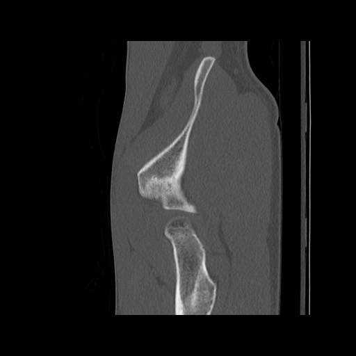 Normal pelvis (Radiopaedia 51473-57238 Sagittal bone window 124).jpg