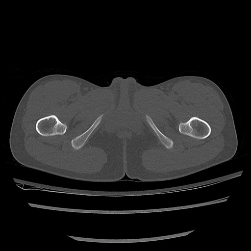 Normal pelvis CT (Radiopaedia 51471-57236 Axial bone window 100).jpg