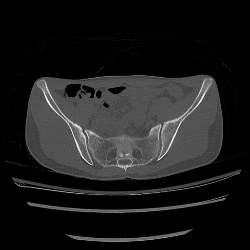 Normal pelvis CT (Radiopaedia 51471-57236 Axial bone window 36).jpg