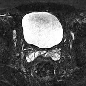 File:Normal prostate (MRI) (Radiopaedia 29986-30535 Axial STIR 21).jpg