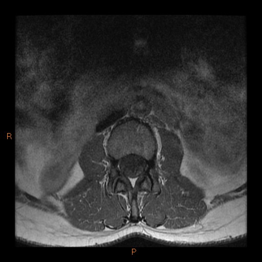 File:Normal spine MRI (Radiopaedia 77323-89408 Axial T1 1).jpg