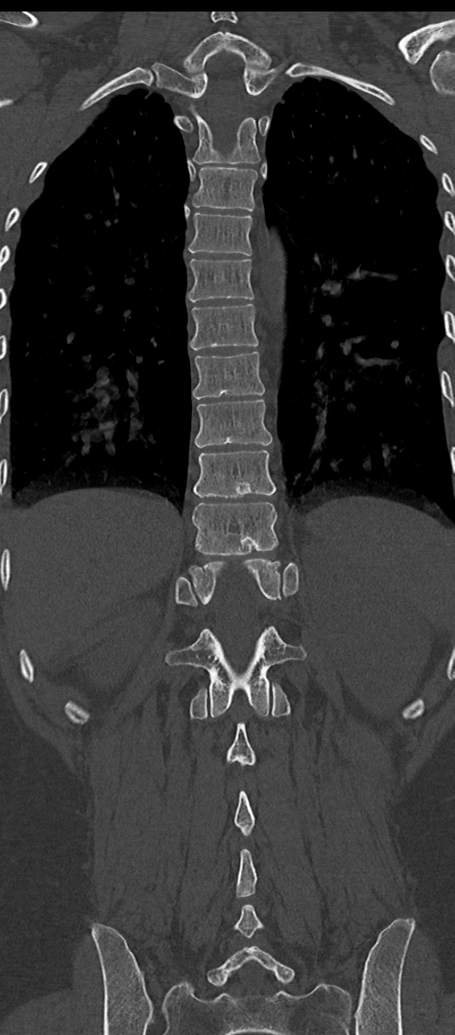 Normal thoracolumbar spine (Radiopaedia 43822-47309 Coronal bone window 61).png