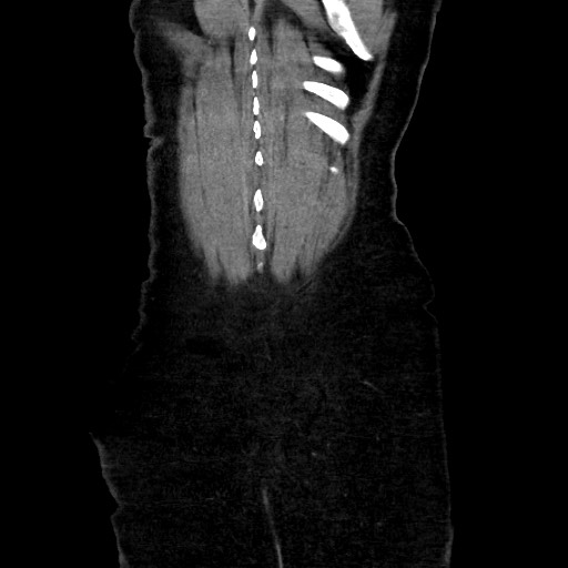 Obstructive distal colonic adenocarcinoma causing cecal perforation (Radiopaedia 86830-102989 C 154).jpg