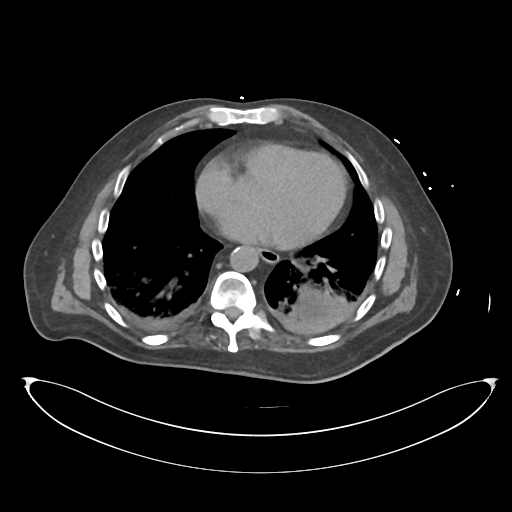 File:Obstructive pyelonephritis (Radiopaedia 46411-50844 Axial non-contrast 7).png