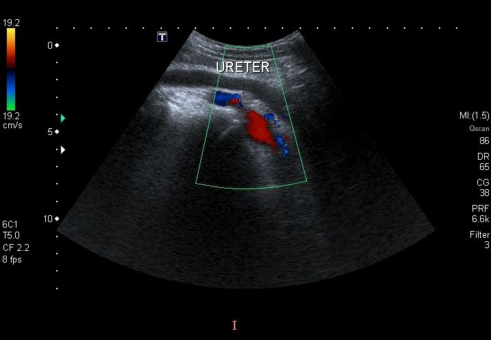 File:Obstructive uropathy and urolithiasis on ultrasound (Radiopaedia 25562-25758 C 1).jpg