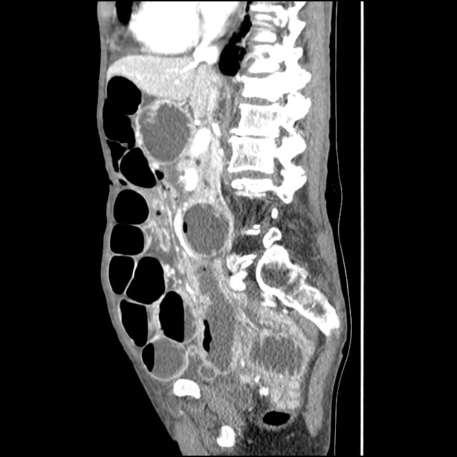 Obturator hernia causing small bowel obstruction (Radiopaedia 65522-74612 C 57).jpg