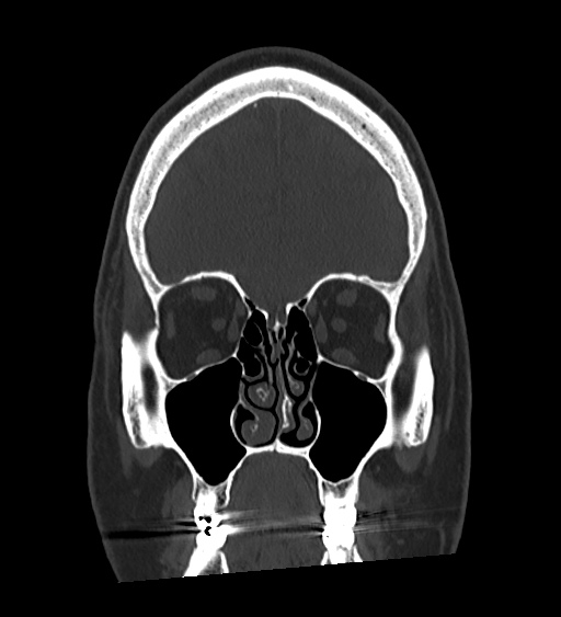Occipital spur and Currarino type A atlas anomaly (Radiopaedia 87027-103285 Coronal bone window 46).jpg