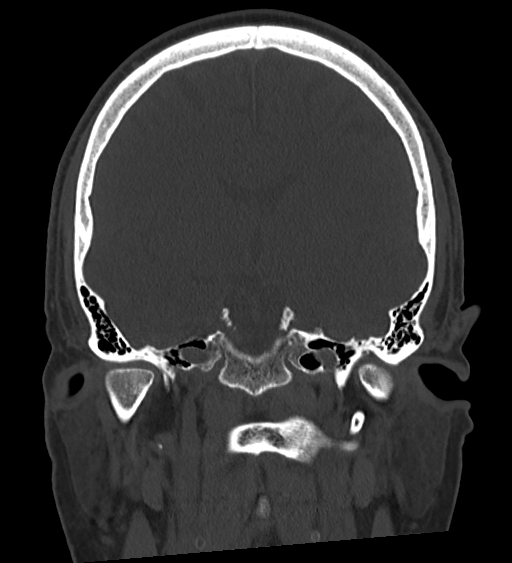 Occipital spur and Currarino type A atlas anomaly (Radiopaedia 87027-103285 Coronal bone window 82).jpg
