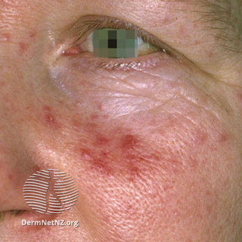Rosacea (DermNet NZ acne-red-face-3607).jpg