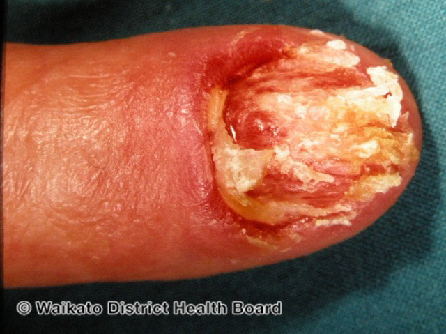 File:Subungual melanoma (DermNet NZ lesions-w-sum2).jpg