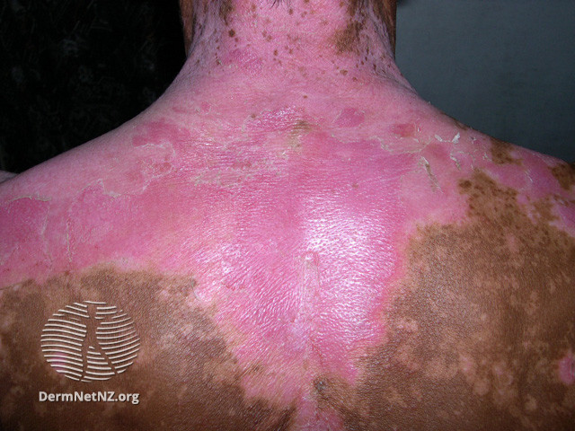 File:Sunburn in vitiligo (DermNet NZ colour-sunburn-vitiligo).jpg