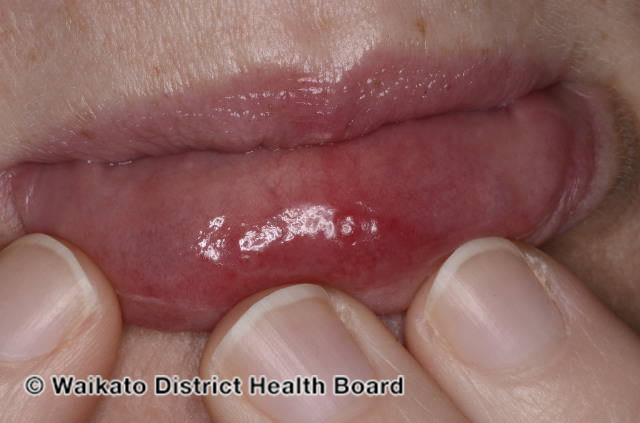File:Sweet syndrome affecting lip (DermNet NZ sweet-lip-1).jpg