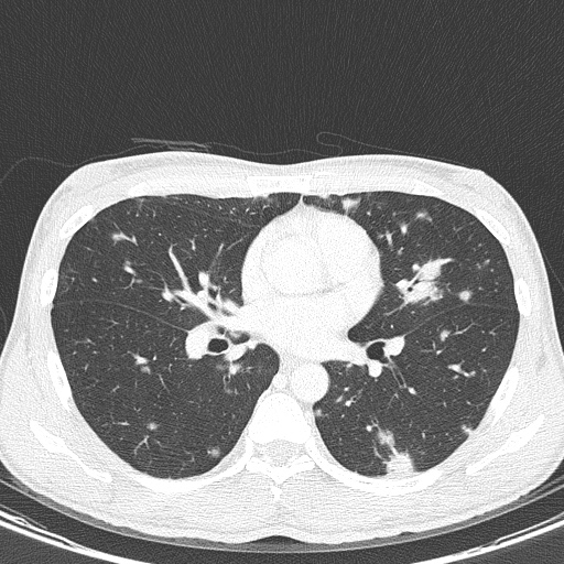 File:AIDS-related Kaposi sarcoma (Radiopaedia 85247-100811 Axial lung window 89).jpg