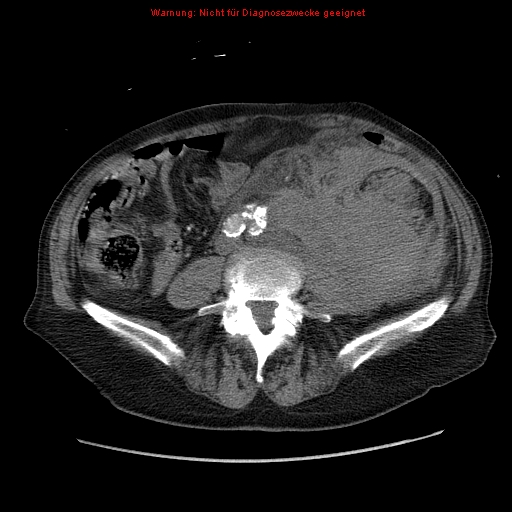 File:Abdominal aortic aneurysm- extremely large, ruptured (Radiopaedia 19882-19921 Axial C+ arterial phase 47).jpg