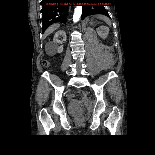 File:Abdominal aortic aneurysm- extremely large, ruptured (Radiopaedia 19882-19921 Coronal C+ arterial phase 71).jpg