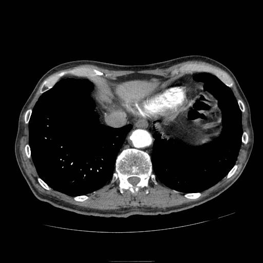 Abdominal aortic aneurysm (Radiopaedia 13341-13340 Axial C+ arterial phase 11).jpg