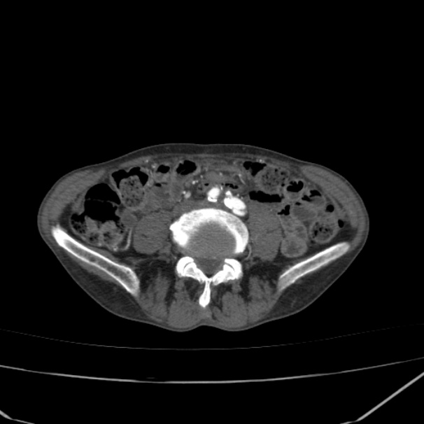 Abdominal aortic aneurysm (Radiopaedia 23703-23856 Axial C+ arterial phase 58).jpg