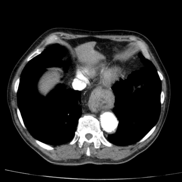 Abdominal aortic aneurysm (Radiopaedia 29248-29660 Axial C+ arterial phase 6).jpg
