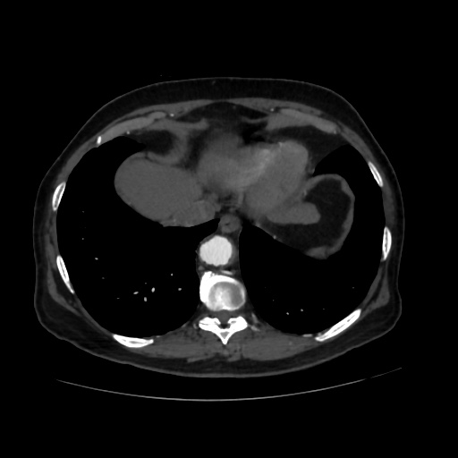 File:Abdominal aortic aneurysm (Radiopaedia 57318-64259 Axial C+ arterial phase 6).jpg