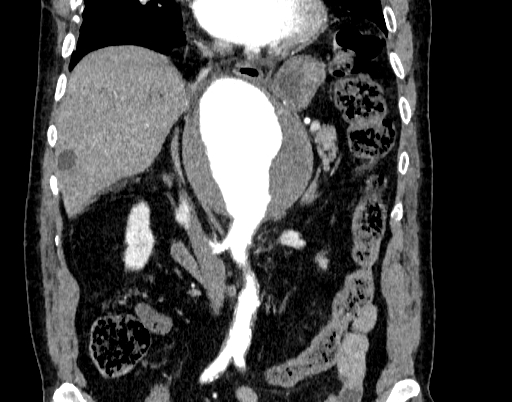 Abdominal aortic aneurysm (Radiopaedia 67117-76452 Coronal C+ arterial phase 46).jpg