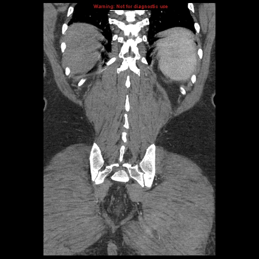 Abdominal aortic aneurysm (Radiopaedia 8190-9038 Coronal C+ arterial phase 109).jpg