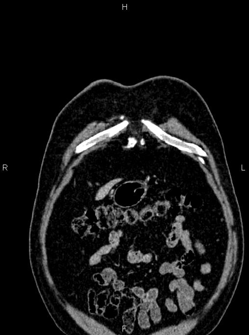 Abdominal aortic aneurysm (Radiopaedia 83094-97462 Coronal renal cortical phase 14).jpg
