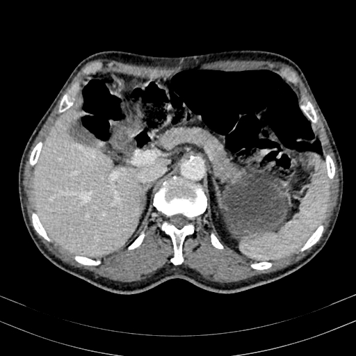 Abdominal aortic aneurysm (Radiopaedia 83581-98689 Axial C+ portal venous phase 30).jpg