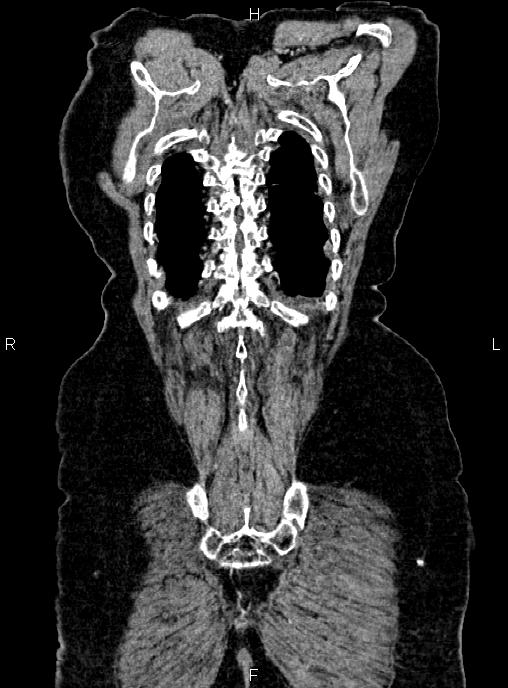 Abdominal aortic aneurysm (Radiopaedia 85063-100606 Coronal C+ arterial phase 56).jpg