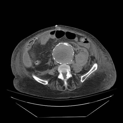 Abdominal aortic aneurysm - impending rupture (Radiopaedia 19233-19247 Axial non-contrast 106).jpg