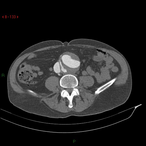 File:Abdominal aortic aneurysm rupture with aortocaval fistula (Radiopaedia 14897-14841 Axial C+ arterial phase 133).jpg