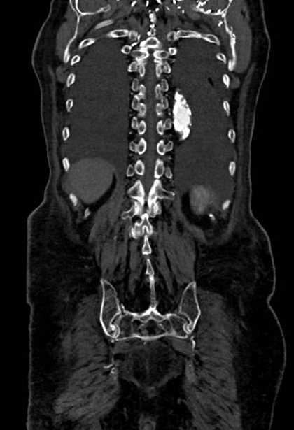 Abdominal aortic aneurysm with thrombus fissuration (Radiopaedia 73192-83919 Coronal C+ arterial phase 77).jpg
