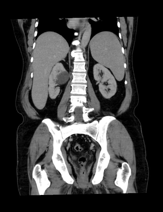 Abdominal lymphoma - with sandwich sign (Radiopaedia 53486-59492 C+ portal venous phase 19).jpg