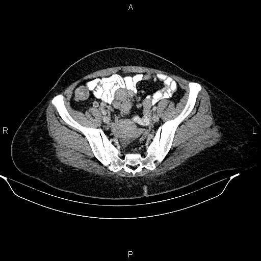 File:Abdominal lymphoma with sandwich sign (Radiopaedia 84378-99704 Axial C+ portal venous phase 46).jpg