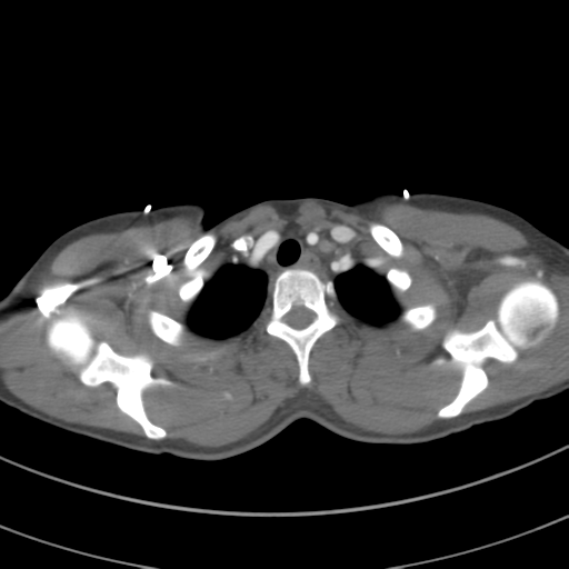 File:Abdominal multi-trauma - devascularised kidney and liver, spleen and pancreatic lacerations (Radiopaedia 34984-36486 Axial C+ arterial phase 13).png