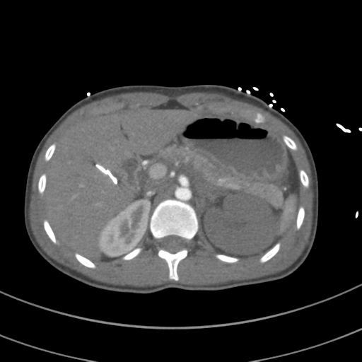 Abdominal multi-trauma - devascularised kidney and liver, spleen and pancreatic lacerations (Radiopaedia 34984-36486 Axial C+ arterial phase 95).png