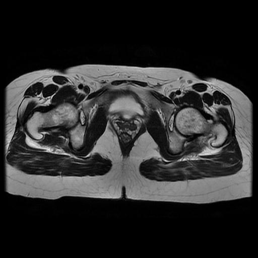 File:Abdominal wall endometriosis (Radiopaedia 83702-98847 Axial T2 16).jpg
