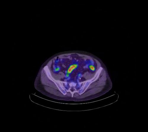 Abdominal wall metastasis from colorectal carcinoma (Radiopaedia 31016-31719 Axial 40).jpg