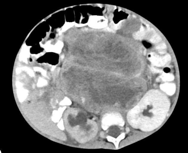 Abdominopelvic rhabdomyosarcoma (Radiopaedia 78356-90984 Axial C+ portal venous phase 85).jpg